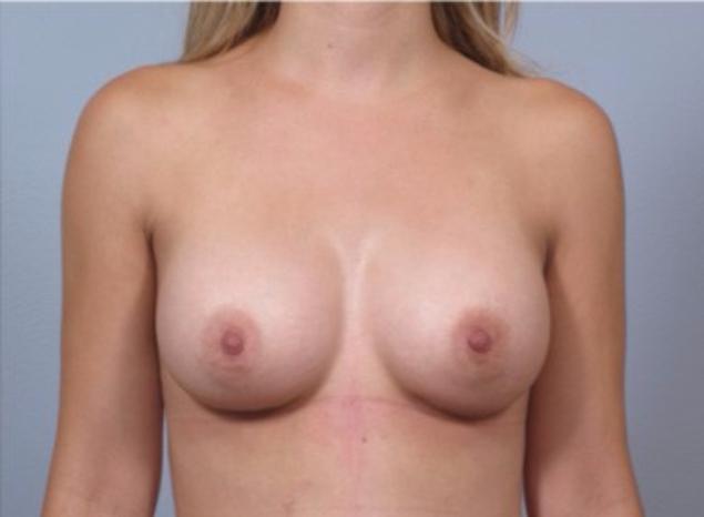 Dr. Diane Duncan breast augmentation after — Fort Collins, CO