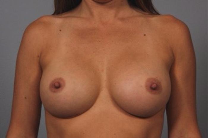 Dr. Diane Duncan breast augmentation after — Fort Collins, CO