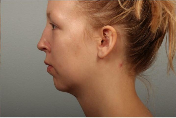 Dr. Diane Duncan facelift after — Fort Collins, CO
