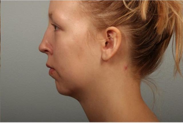 Mini Facelift after at Dr. Diane Duncan in Fort Collins, CO