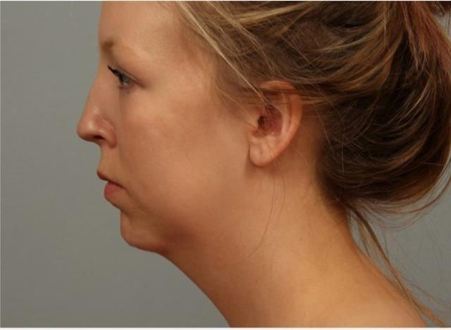 Mini Facelift before at Dr. Diane Duncan in Fort Collins, CO