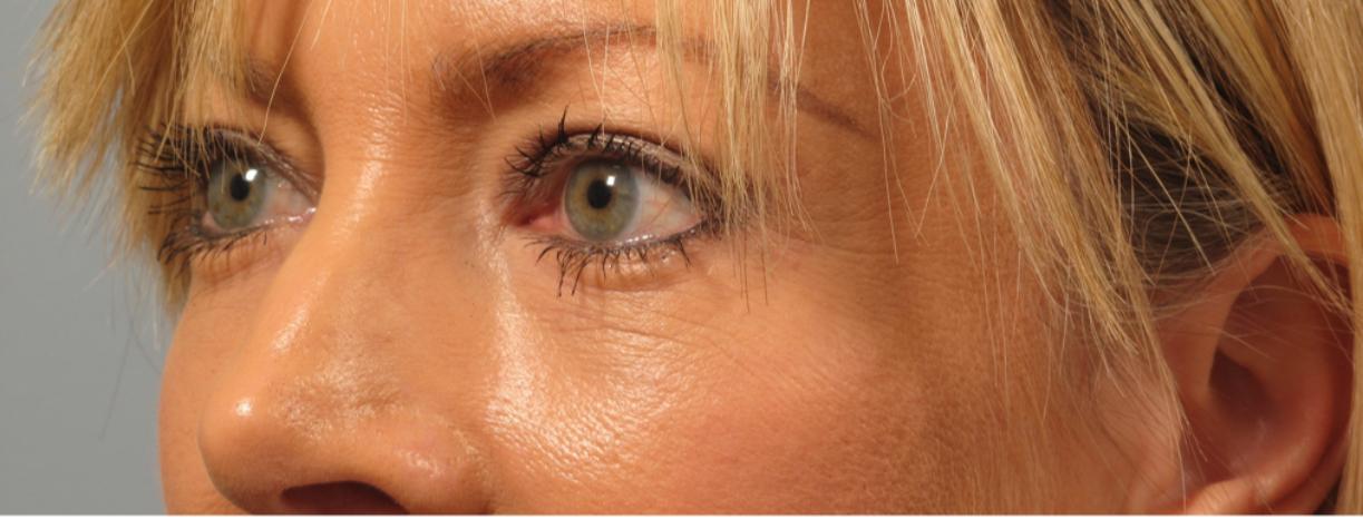 Dr. Diane Duncan blepharoplasty after — Fort Collins, CO
