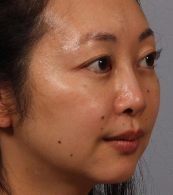 Dr. Diane Duncan rhinoplasty after — Fort Collins, CO