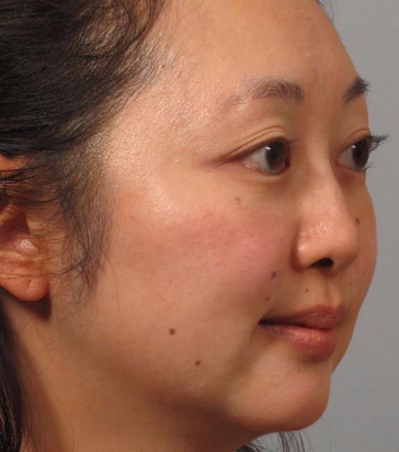 Functional Rhinoplasty before at Dr. Diane Duncan in Fort Collins, CO