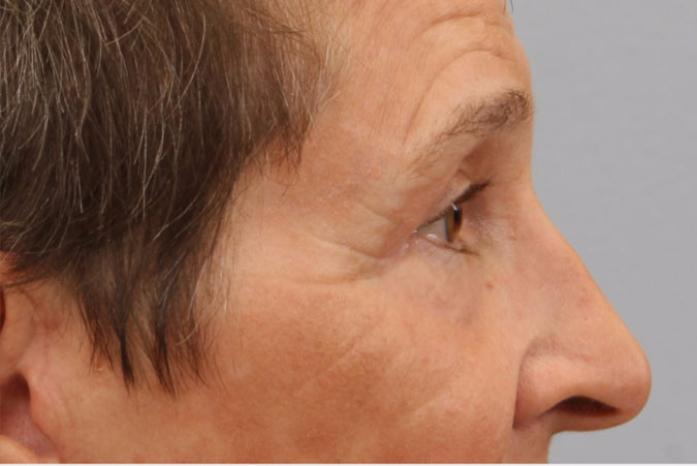 Dr. Diane Duncan blepharoplasty after — Fort Collins, CO