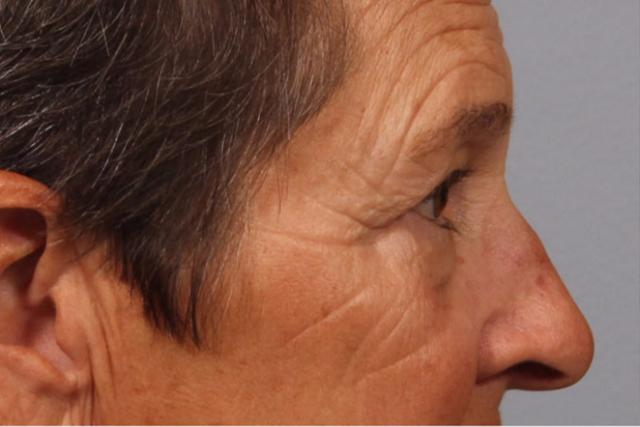 Blepharoplasty before at Dr. Diane Duncan in Fort Collins, CO