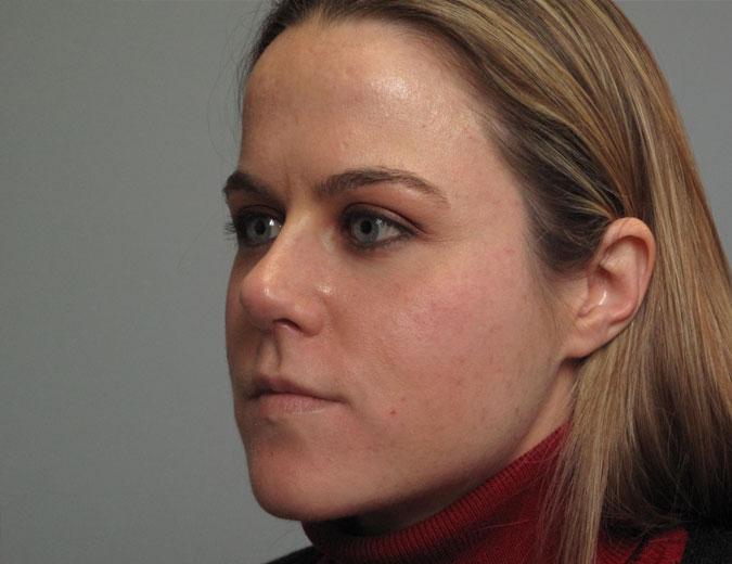 Dr. Diane Duncan rhinoplasty after — Fort Collins, CO