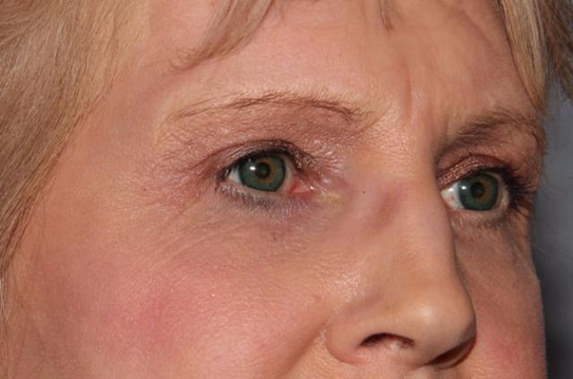 Brow Lift after at Dr. Diane Duncan in Fort Collins, CO