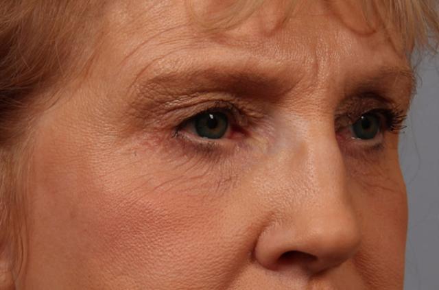 Brow Lift before at Dr. Diane Duncan in Fort Collins, CO