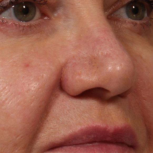 Dr. Diane Duncan rhinoplasty after — Fort Collins, CO