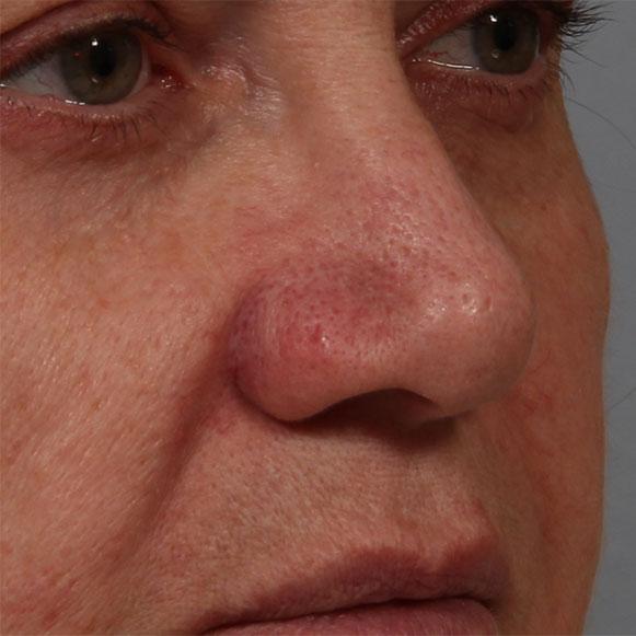 Functional Rhinoplasty before at Dr. Diane Duncan in Fort Collins, CO