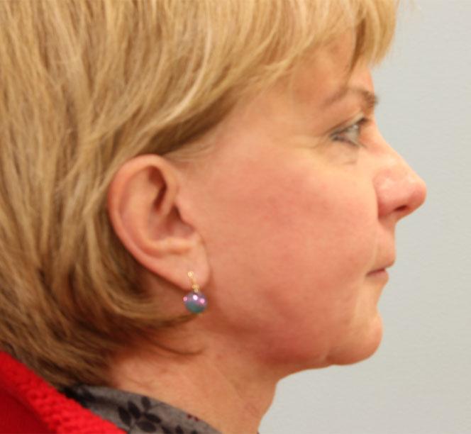 Dr. Diane Duncan rhinoplasty after — Fort Collins, CO