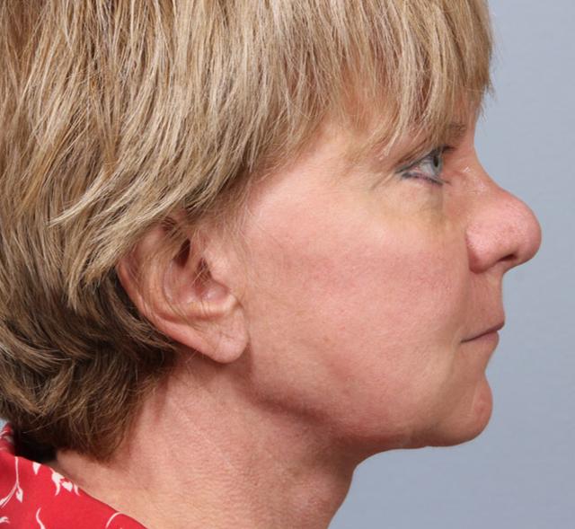 Functional Rhinoplasty before at Dr. Diane Duncan in Fort Collins, CO