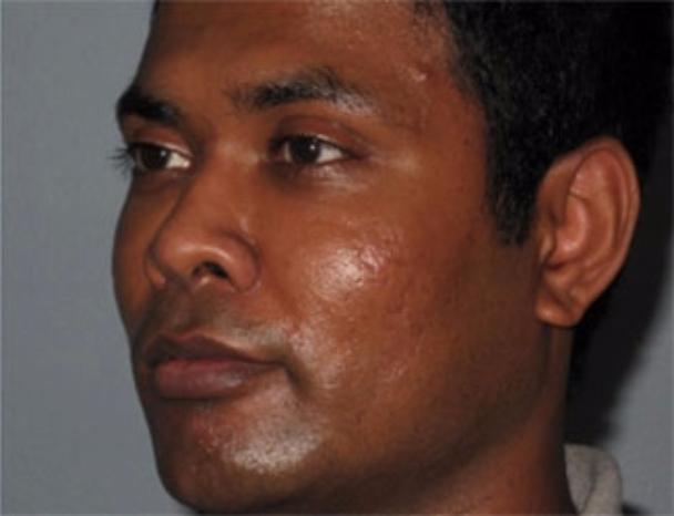 Dr. Diane Duncan rhinoplasty after — Fort Collins, CO