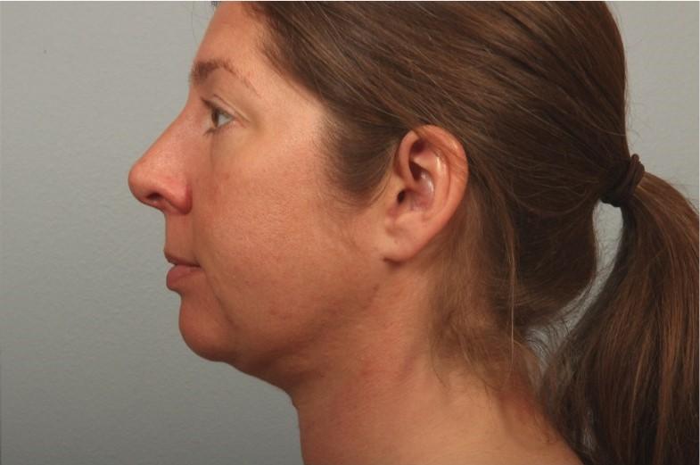 Dr. Diane Duncan facelift after — Fort Collins, CO