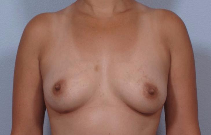 Dr. Diane Duncan breast lift after — Fort Collins, CO