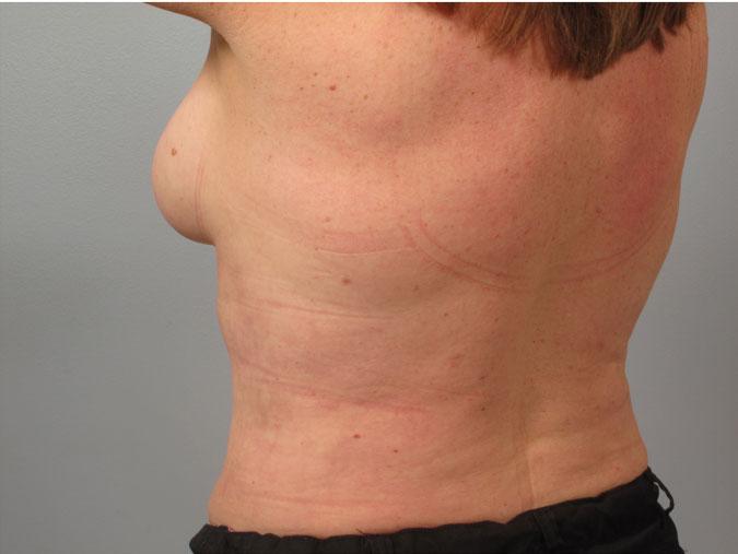 Dr. Diane Duncan liposuction after — Fort Collins, CO