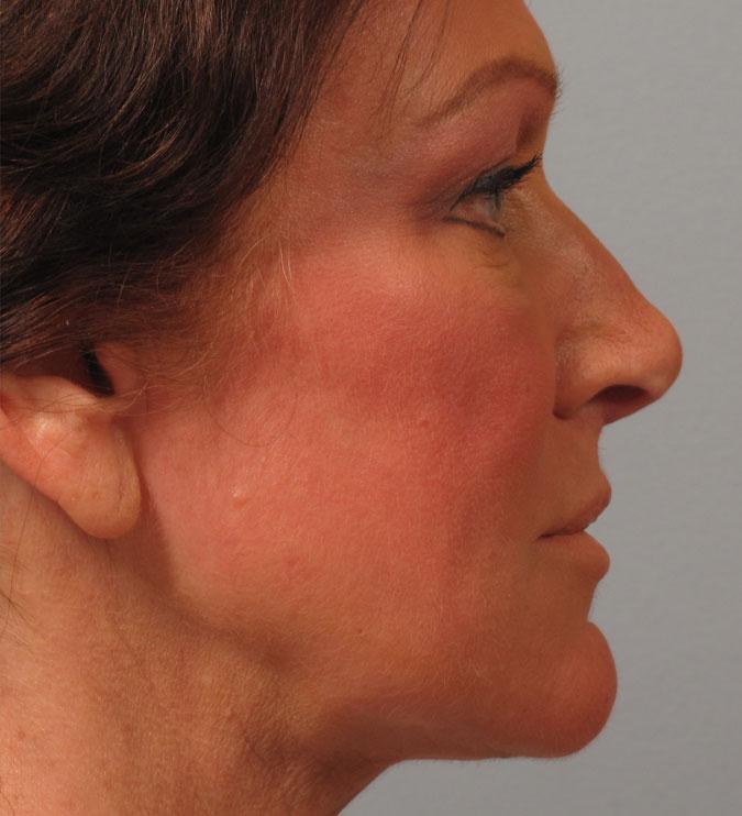 Dr. Diane Duncan rhinoplasty after — Fort Collins, CO