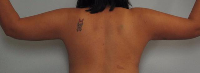 Arm Lift after at Dr. Diane Duncan in Fort Collins, CO