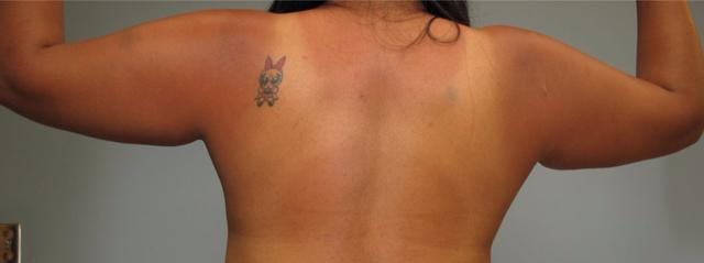 Arm Lift before at Dr. Diane Duncan in Fort Collins, CO