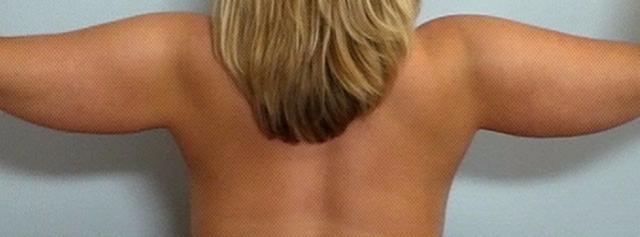 Arm Lift before at Dr. Diane Duncan in Fort Collins, CO