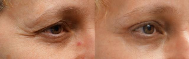 Laser Skin Resurfacing result at Jeffrey Joseph, M.D. - Ophthalmic Plastic and Reconstructive Surgery in Newport Beach, CA