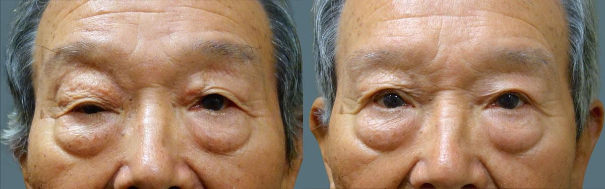 Jeffrey Joseph, M.D. - Ophthalmic Plastic and Reconstructive Surgery blepharoplasty result — Newport Beach, CA