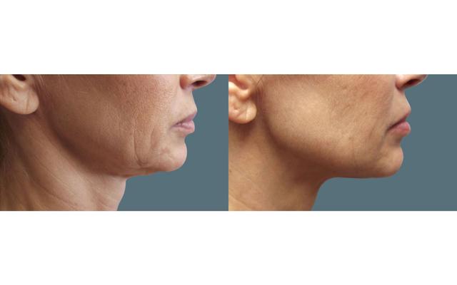 Morpheus8 result at Jeffrey Joseph, M.D. - Ophthalmic Plastic and Reconstructive Surgery in Newport Beach, CA