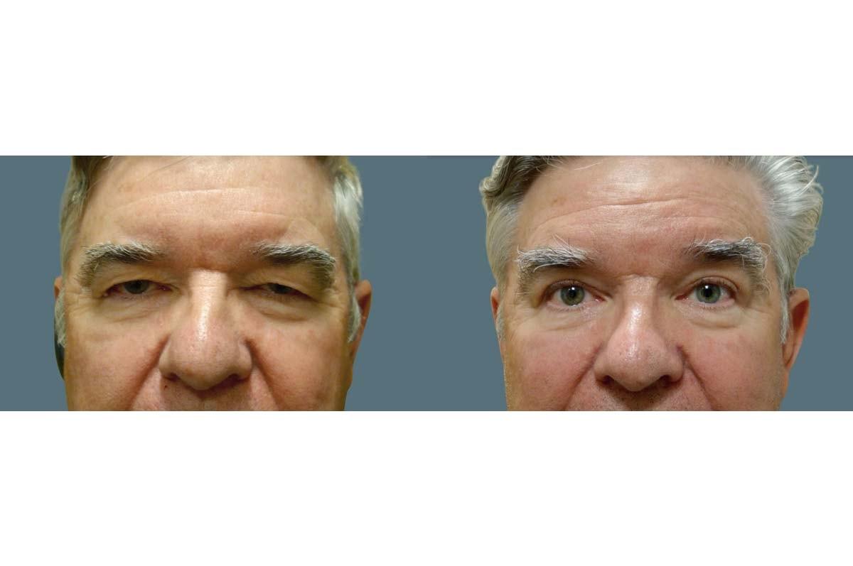 Jeffrey Joseph, M.D. - Ophthalmic Plastic and Reconstructive Surgery blepharoplasty result — Newport Beach, CA