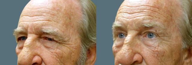 Brow Lift result at Jeffrey Joseph, M.D. - Ophthalmic Plastic and Reconstructive Surgery in Newport Beach, CA