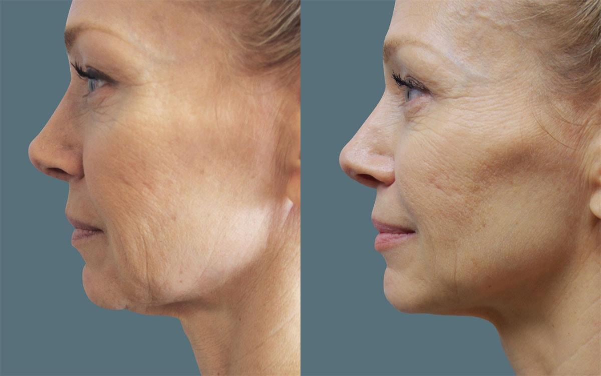 Jeffrey Joseph, M.D. - Ophthalmic Plastic and Reconstructive Surgery skin tightening result — Newport Beach, CA