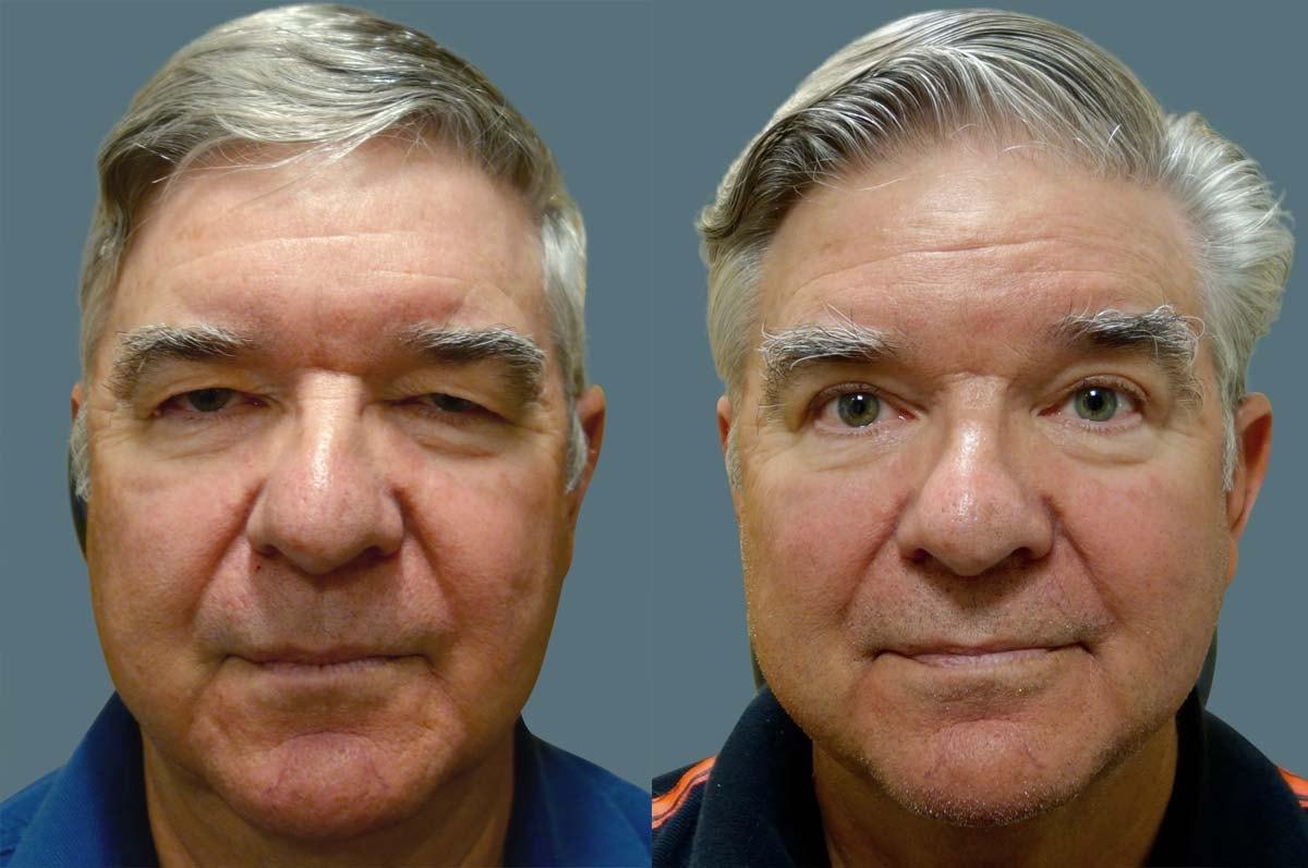 Jeffrey Joseph, M.D. - Ophthalmic Plastic and Reconstructive Surgery blepharoplasty result — Newport Beach, CA
