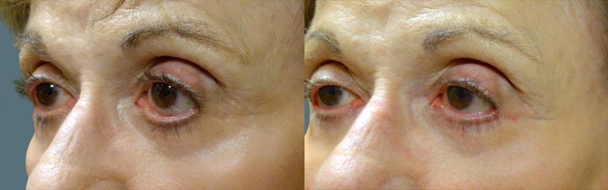 Jeffrey Joseph, M.D. - Ophthalmic Plastic and Reconstructive Surgery blepharoplasty result — Newport Beach, CA