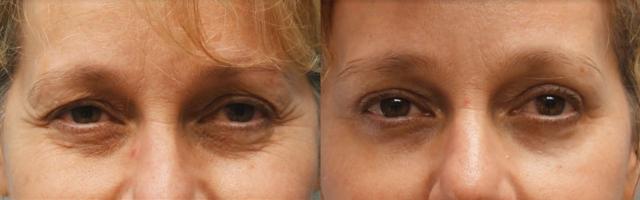 Laser Skin Resurfacing result at Jeffrey Joseph, M.D. - Ophthalmic Plastic and Reconstructive Surgery in Newport Beach, CA