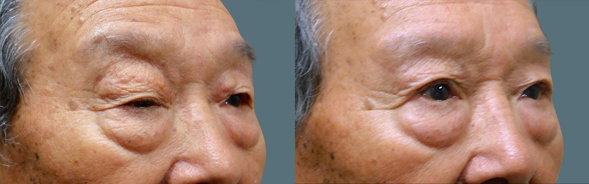Jeffrey Joseph, M.D. - Ophthalmic Plastic and Reconstructive Surgery blepharoplasty result — Newport Beach, CA