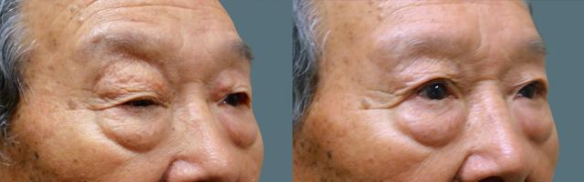Blepharoplasty result at Jeffrey Joseph, M.D. - Ophthalmic Plastic and Reconstructive Surgery in Newport Beach, CA