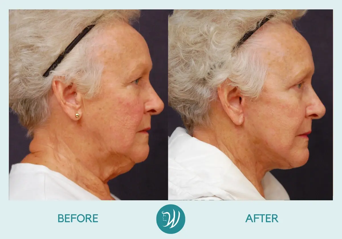 Winslow Facial Plastic Surgery: Catherine Winslow MD facelift result — Carmel, IN