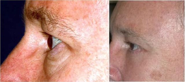 Blepharoplasty result at Winslow Facial Plastic Surgery: Catherine Winslow MD in Carmel, IN