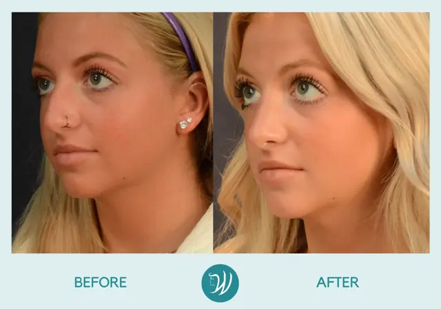 Rhinoplasty result at Winslow Facial Plastic Surgery: Catherine Winslow MD in Carmel, IN
