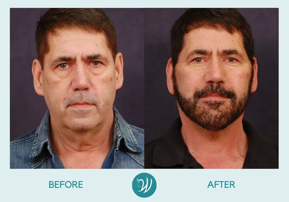 Winslow Facial Plastic Surgery: Catherine Winslow MD facelift result — Carmel, IN
