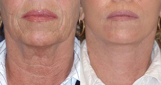 Morpheus8 result at Winslow Facial Plastic Surgery: Catherine Winslow MD in Carmel, IN
