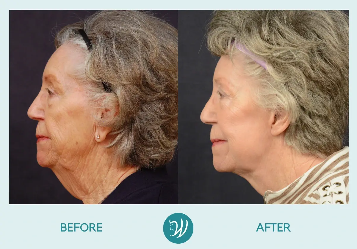 Winslow Facial Plastic Surgery: Catherine Winslow MD facelift result — Carmel, IN