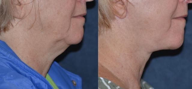 Neck Lift result at Winslow Facial Plastic Surgery: Catherine Winslow MD in Carmel, IN