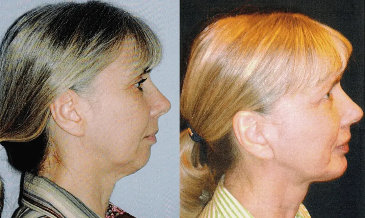 Winslow Facial Plastic Surgery: Catherine Winslow MD facelift result — Carmel, IN