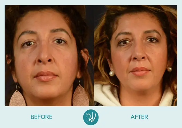 Rhinoplasty result at Winslow Facial Plastic Surgery: Catherine Winslow MD in Carmel, IN