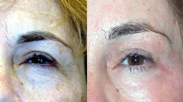 Chemical Peel result at Winslow Facial Plastic Surgery: Catherine Winslow MD in Carmel, IN
