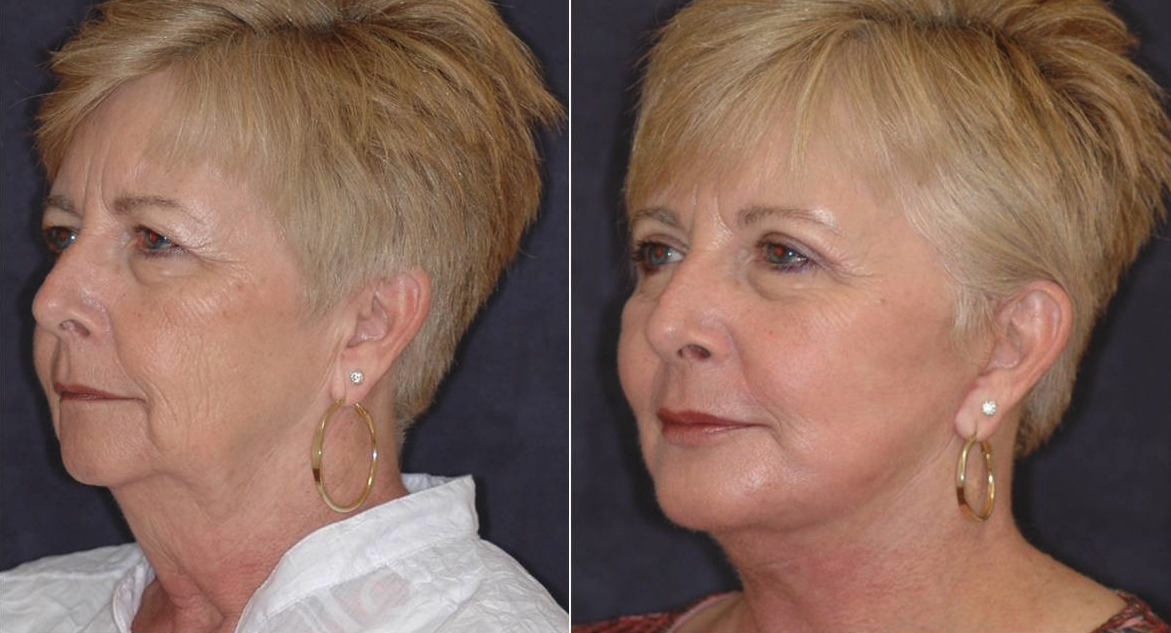 Winslow Facial Plastic Surgery: Catherine Winslow MD facelift result — Carmel, IN