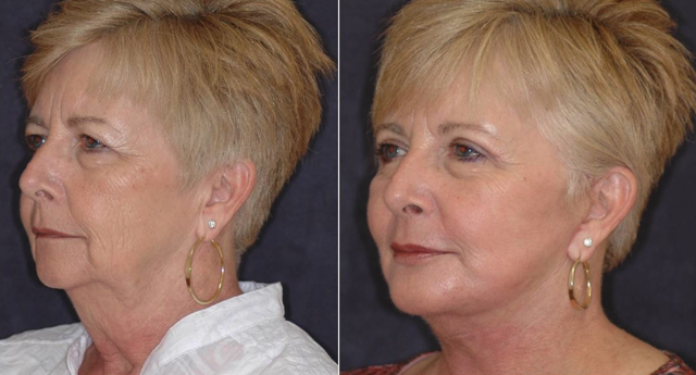 Deep Plane Facelift result at Winslow Facial Plastic Surgery: Catherine Winslow MD in Carmel, IN