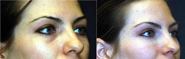Lip Filler result at Winslow Facial Plastic Surgery: Catherine Winslow MD in Carmel, IN