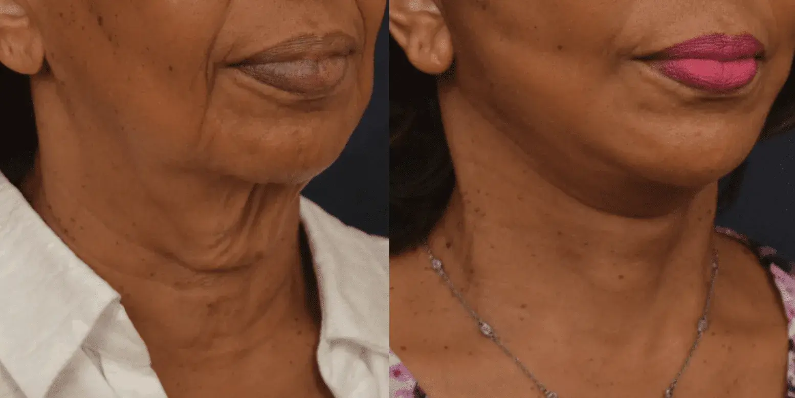 Winslow Facial Plastic Surgery: Catherine Winslow MD facelift result — Carmel, IN